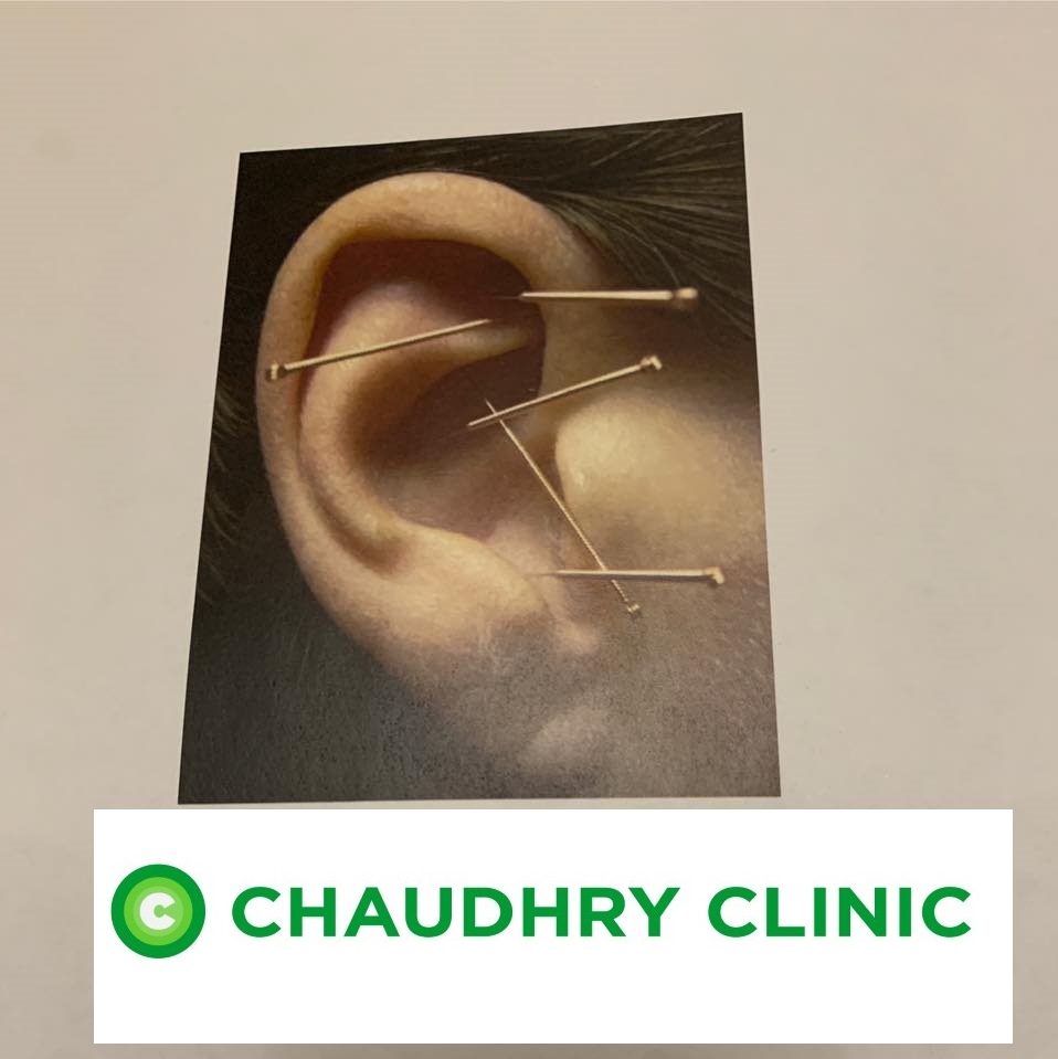 ear acupuncture