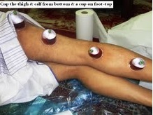 hijama on the leg