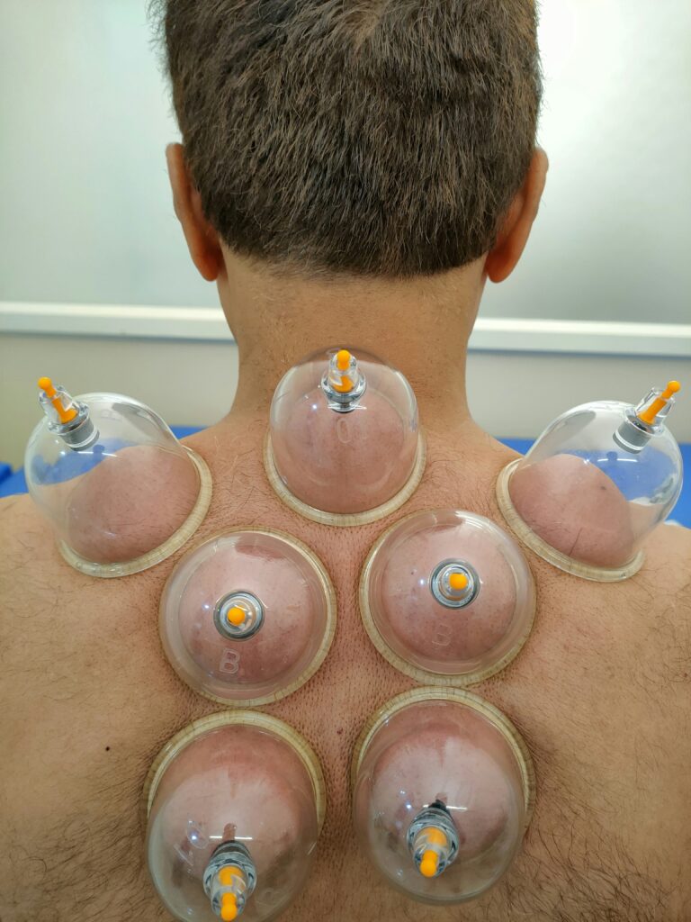 hijama cupping