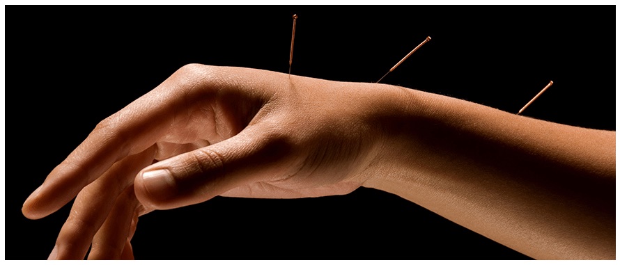 hand acupuncture